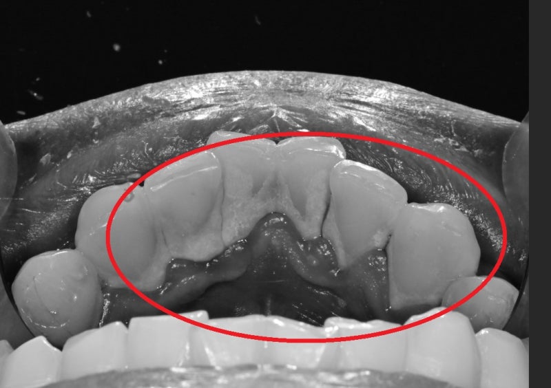 クムナムシジャン歯科、歯茎の炎症が起きた場合の原因と治療法は？（歯磨きで血が出ます、歯の色がおかしいです） 사진 4