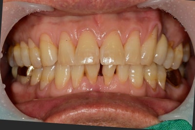 Nha khoa Oksu, nha khoa có thể làm răng ngay trong ngày phẫu thuật cấy ghép implant Oksu?? (Phục hình thẩm mỹ, cấy ghép