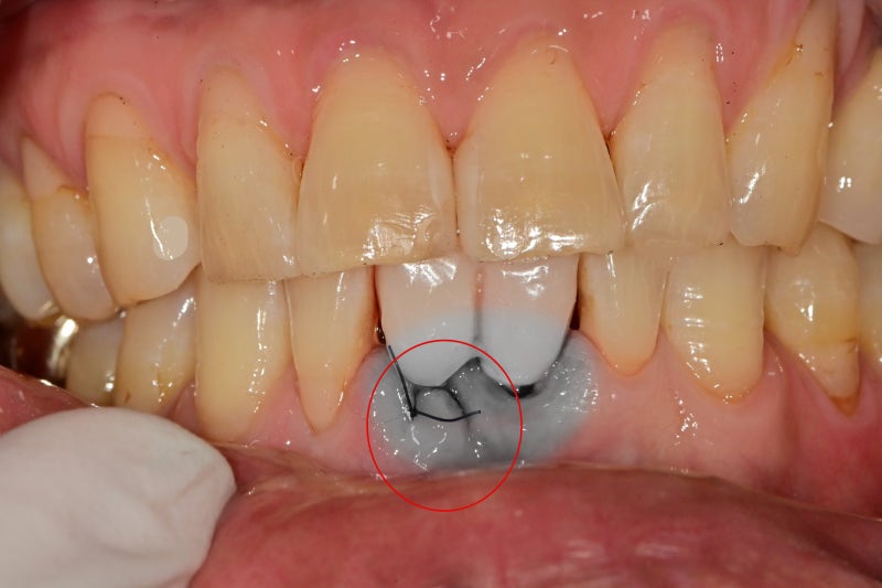 Nha khoa Oksu, nha khoa có thể làm răng ngay trong ngày phẫu thuật cấy ghép implant Oksu?? (Phục hình thẩm mỹ, cấy ghép