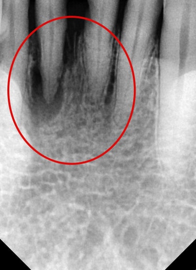 Nha khoa Oksu, nha khoa có thể làm răng ngay trong ngày phẫu thuật cấy ghép implant Oksu?? (Phục hình thẩm mỹ, cấy ghép