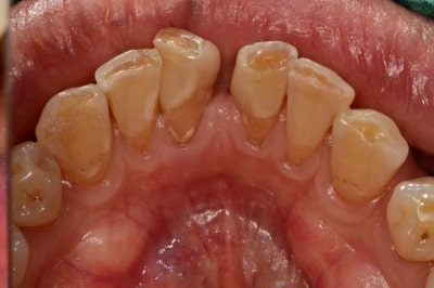 Nha khoa Oksu, nha khoa có thể làm răng ngay trong ngày phẫu thuật cấy ghép implant Oksu?? (Phục hình thẩm mỹ, cấy ghép