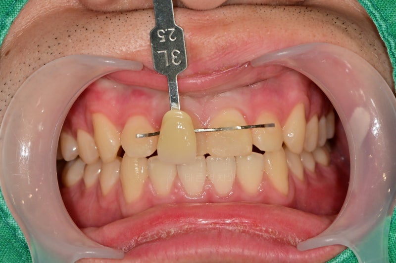 Yaksu Station Dental Clinic: Treating Loose Teeth After Falls or Trauma (Esthetic Prosthetics, Root Canal Treatment, Too