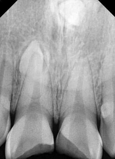 Yaksu Station Dental Clinic: Treating Loose Teeth After Falls or Trauma (Esthetic Prosthetics, Root Canal Treatment, Too