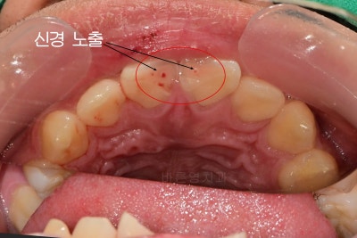 Yaksu Station Dental Clinic: Treating Loose Teeth After Falls or Trauma (Esthetic Prosthetics, Root Canal Treatment, Too