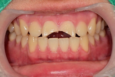 Yaksu Station Dental Clinic: Treating Loose Teeth After Falls or Trauma (Esthetic Prosthetics, Root Canal Treatment, Too