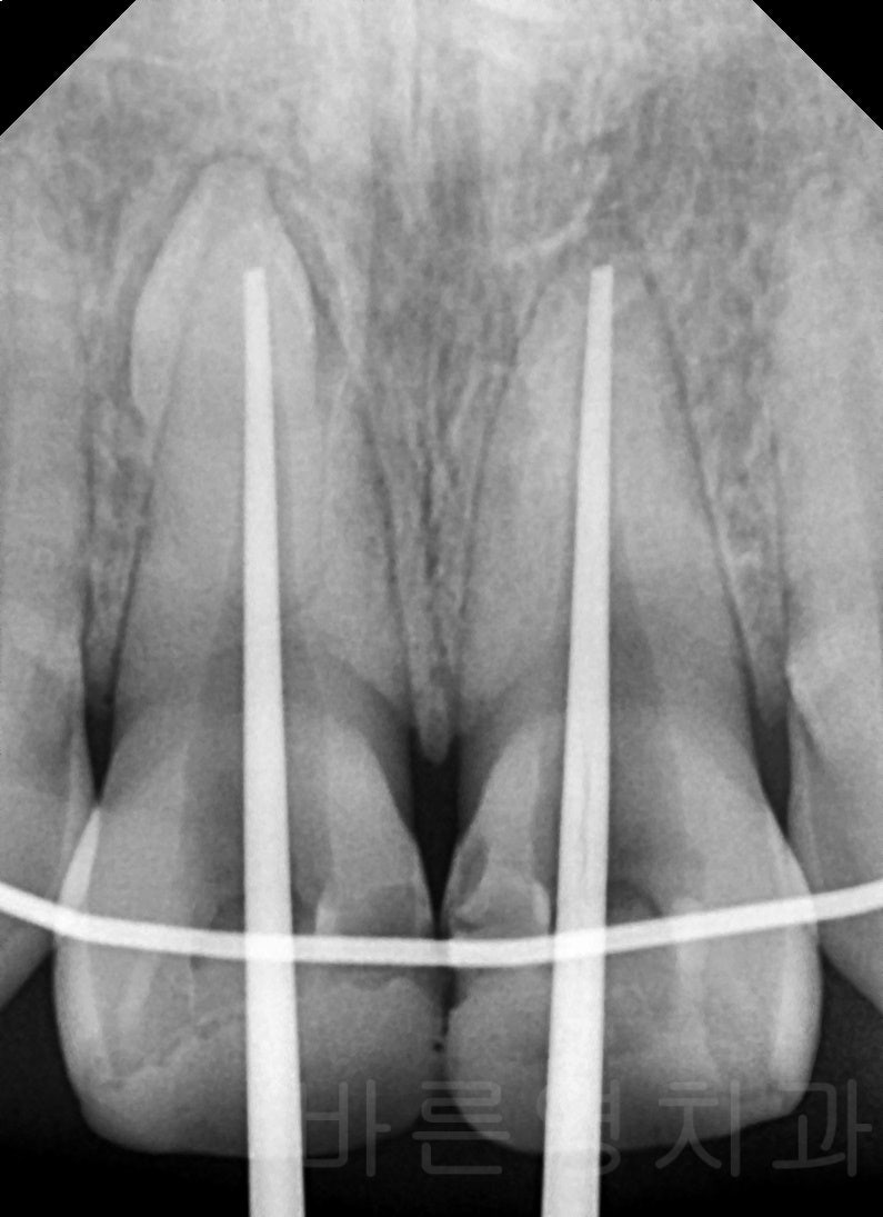 Yaksu Station Dental Clinic: Treating Loose Teeth After Falls or Trauma (Esthetic Prosthetics, Root Canal Treatment, Too
