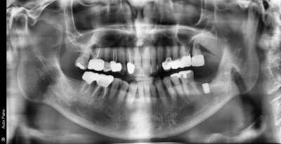 Shindang Station Dental Clinic: Do I have to remove wisdom teeth for implant surgery? (How long do I have to wait for im
