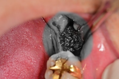 Shindang Station Dental Clinic: Do I have to remove wisdom teeth for implant surgery? (How long do I have to wait for im