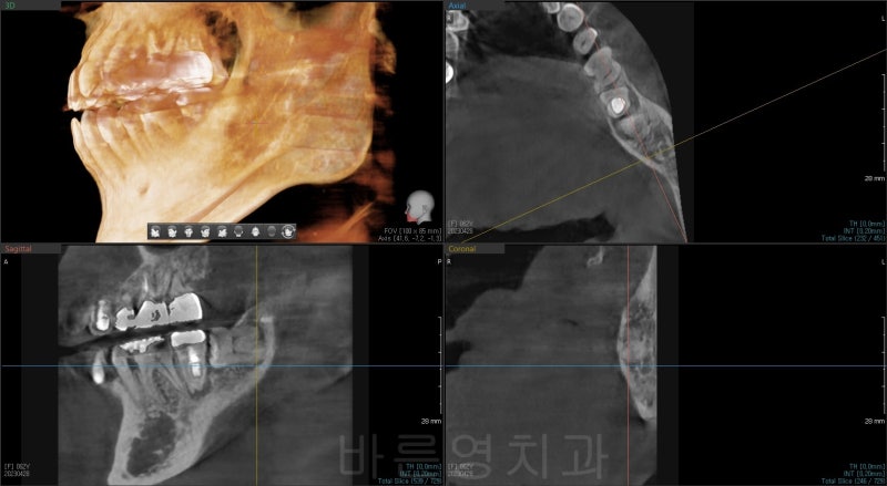 신당역 치과, 임플란트를 수술을 위해 사랑니는 꼭 빼야 하나요?? (얼마나 기다려야 임플란트 치료가 가능한가요?)