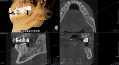 Shindang Station Dental Clinic: Do I have to remove wisdom teeth for implant surgery? (How long do I have to wait for im