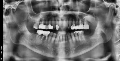 Shindang Station Dental Clinic: Do I have to remove wisdom teeth for implant surgery? (How long do I have to wait for im