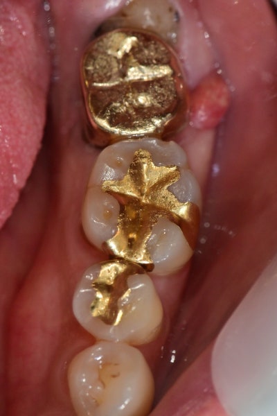 Shindang Station Dental Clinic: Do I have to remove wisdom teeth for implant surgery? (How long do I have to wait for im