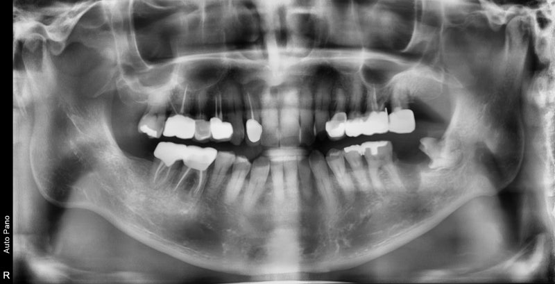 Shindang Station Dental Clinic: Do I have to remove wisdom teeth for implant surgery? (How long do I have to wait for im