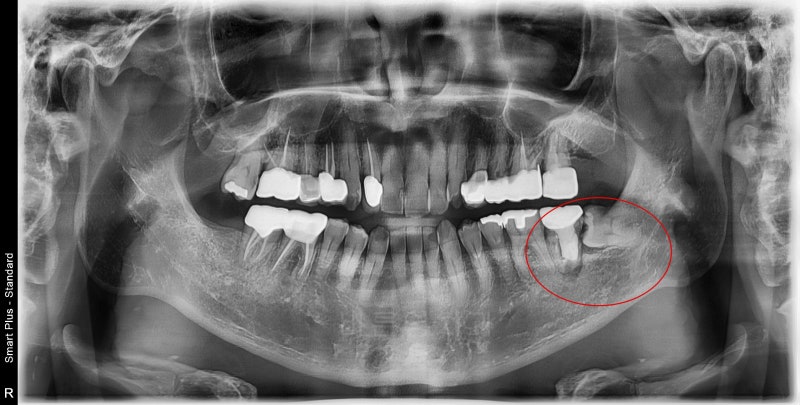 Shindang Station Dental Clinic: Do I have to remove wisdom teeth for implant surgery? (How long do I have to wait for im