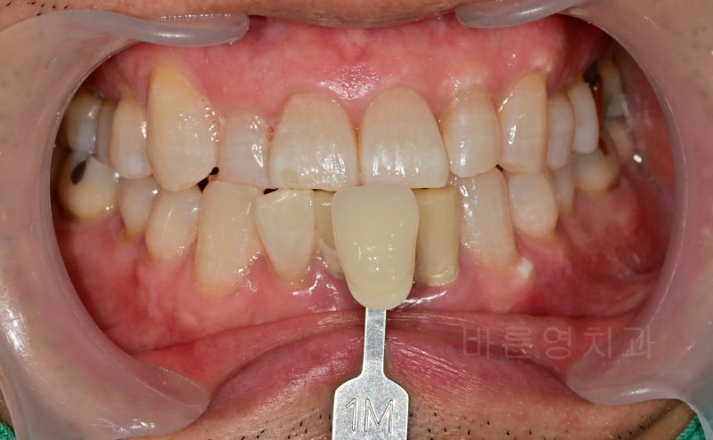 Kumho-dong Dental Clinic: Achieving Brighter Teeth with Whitening During Anterior Prosthetic Treatment 사진 3