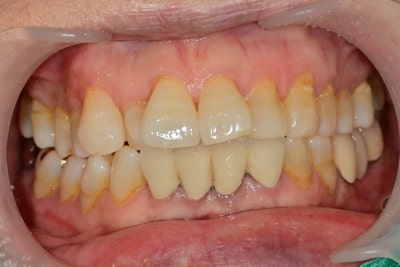 Kumho-dong Dental Clinic: Achieving Brighter Teeth with Whitening During Anterior Prosthetic Treatment 사진 6