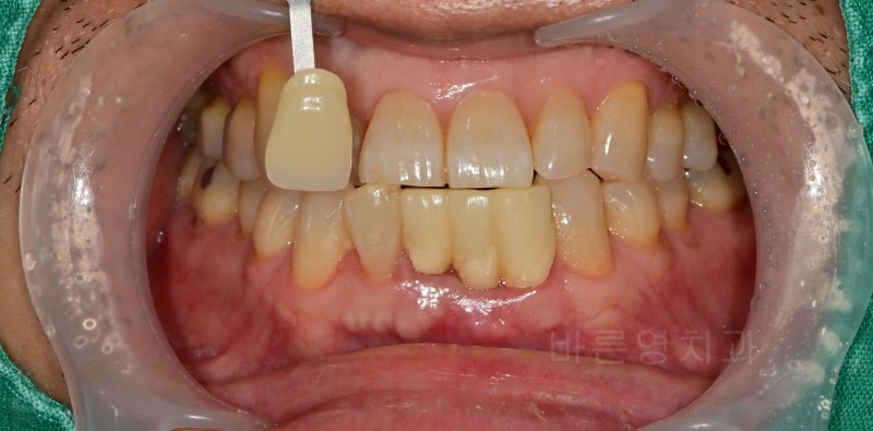 Kumho-dong Dental Clinic: Achieving Brighter Teeth with Whitening During Anterior Prosthetic Treatment 사진 2