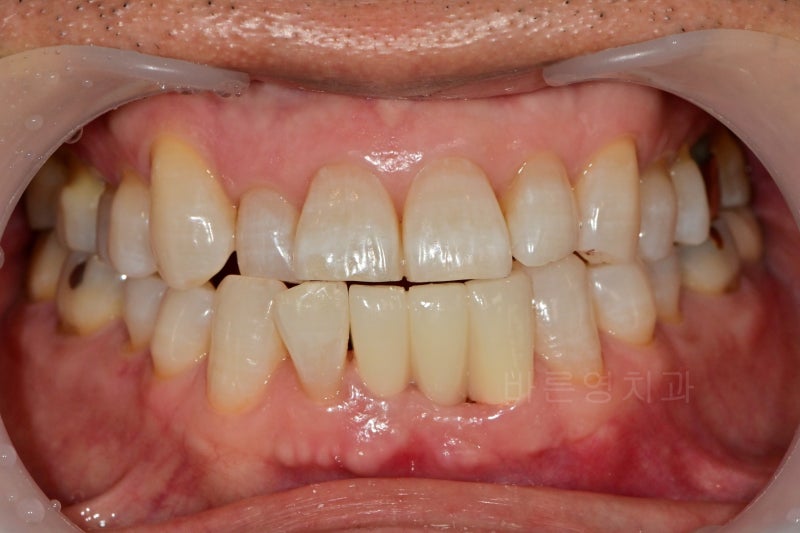 Kumho-dong Dental Clinic: Achieving Brighter Teeth with Whitening During Anterior Prosthetic Treatment 사진 4