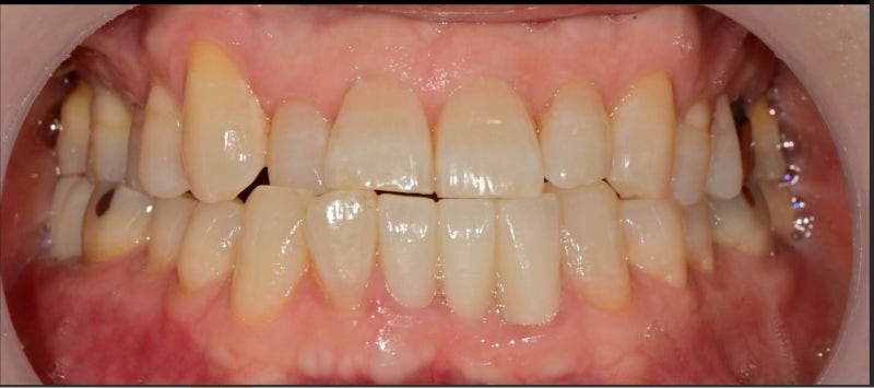 Kumho-dong Dental Clinic: Achieving Brighter Teeth with Whitening During Anterior Prosthetic Treatment 사진 5