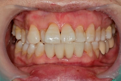 Kumho-dong Dental Clinic: Achieving Brighter Teeth with Whitening During Anterior Prosthetic Treatment 사진 7