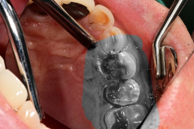 Kumho Station Dental Clinic: When Implant Treatment is Needed After a Fractured (Cracked) Tooth Treatment 사진 3