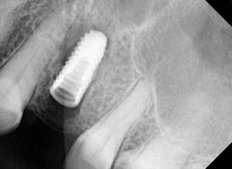 Kumho Station Dental Clinic: When Implant Treatment is Needed After a Fractured (Cracked) Tooth Treatment 사진 10
