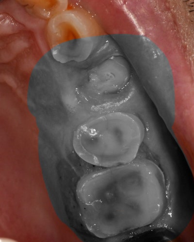 Kumho Station Dental Clinic: When Implant Treatment is Needed After a Fractured (Cracked) Tooth Treatment 사진 7