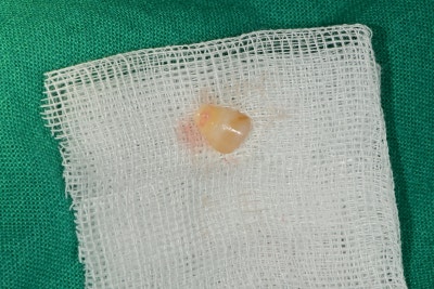 Kumho Station Dental Clinic: When Implant Treatment is Needed After a Fractured (Cracked) Tooth Treatment 사진 4