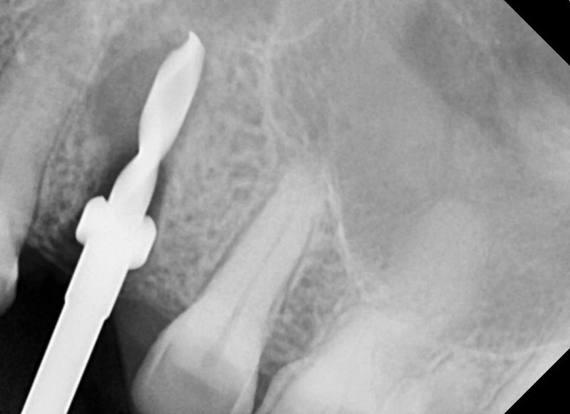 Kumho Station Dental Clinic: When Implant Treatment is Needed After a Fractured (Cracked) Tooth Treatment 사진 9