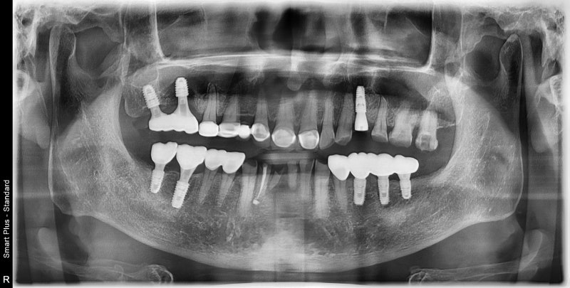 Kumho Station Dental Clinic: When Implant Treatment is Needed After a Fractured (Cracked) Tooth Treatment 사진 11