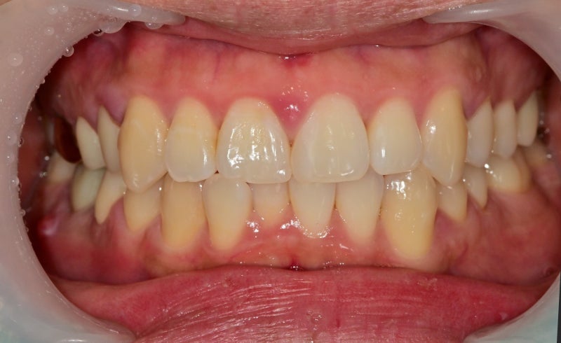 Hannam-dong Dental Clinic: Precautions for Resin Treatment of Gaps Between Front Teeth