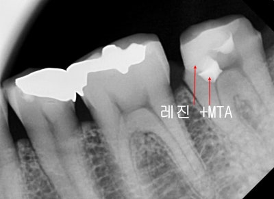 长忠洞牙科,MTA神经治疗时的注意事项(裂纹牙、深龋) 사진 9