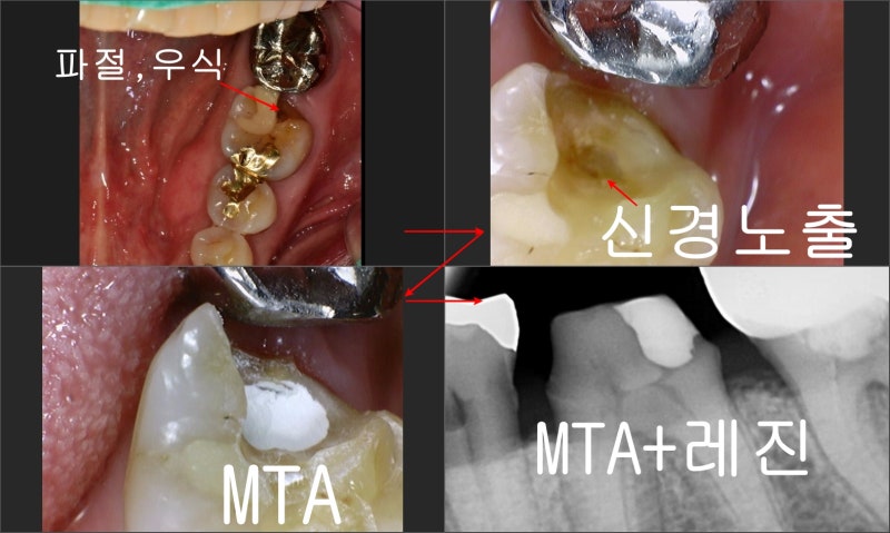 장충동 치과, MTA를 이용한 신경치료 시 주의할 점( 크랙치아, 깊은 충치)