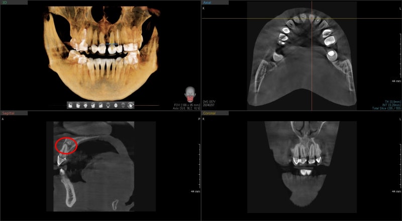 Shindang-dong Dental Clinic: Important Considerations for Anterior Prosthetic Treatment (Esthetic Prosthetics, Root Canal Treatment)