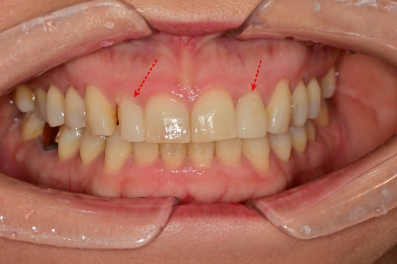 Why Laminates Break at Dongdae Entrance Station Dental Clinic