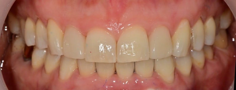 Why Laminates Break at Dongdae Entrance Station Dental Clinic 사진 6
