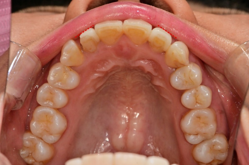 Why Laminates Break at Dongdae Entrance Station Dental Clinic 사진 2