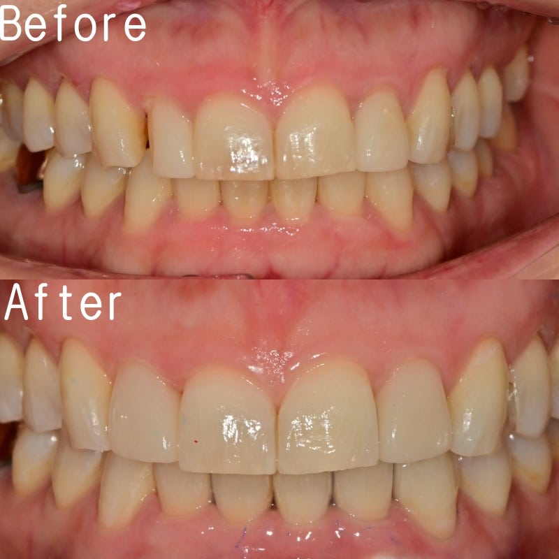 Why Laminates Break at Dongdae Entrance Station Dental Clinic 사진 7