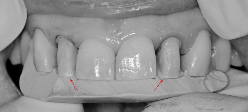 Why Laminates Break at Dongdae Entrance Station Dental Clinic 사진 5