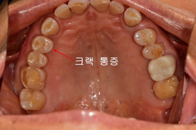 新堂洞牙科:咀嚼时疼痛,种植牙和天然牙的问题 사진 2