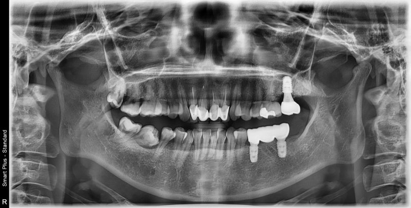 Problems Arising When Too Much Time Passes After a Tooth Extraction Near Singeumho Station Dental Clinic 사진 5