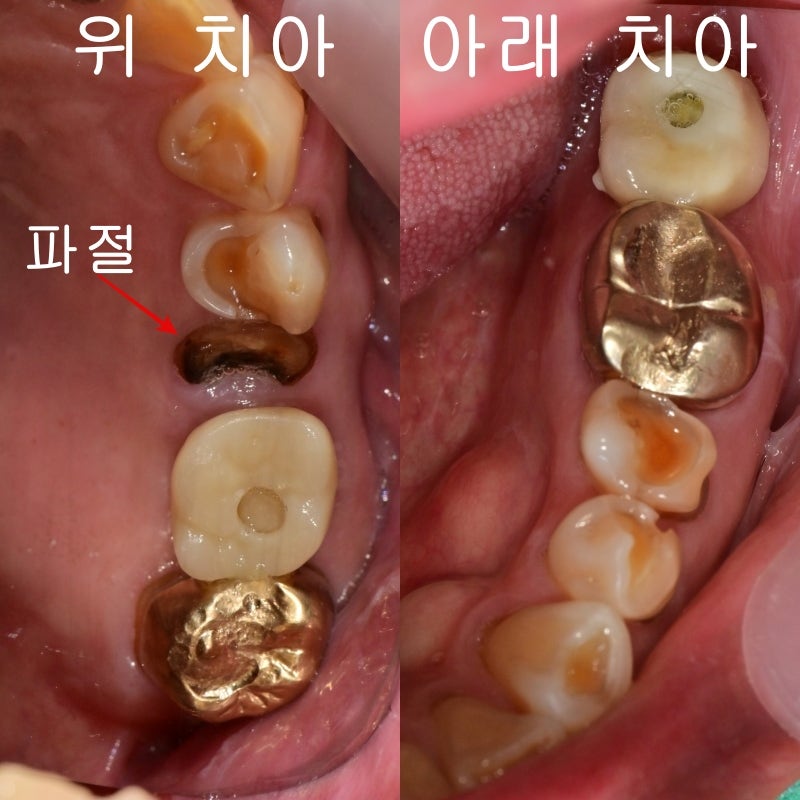 梨泰院站牙科:修复破损和磨损牙齿的方法