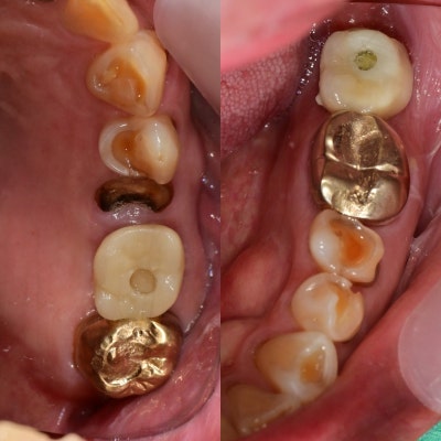 梨泰院站牙科:修复破损和磨损牙齿的方法 사진 5
