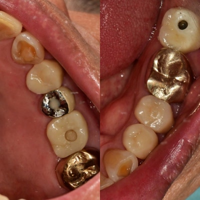 梨泰院站牙科:修复破损和磨损牙齿的方法 사진 6