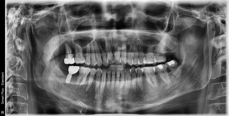 Shindang-dong Dental Clinic: The Impact of Long-Term Tooth Loss on Adjacent Teeth 사진 3