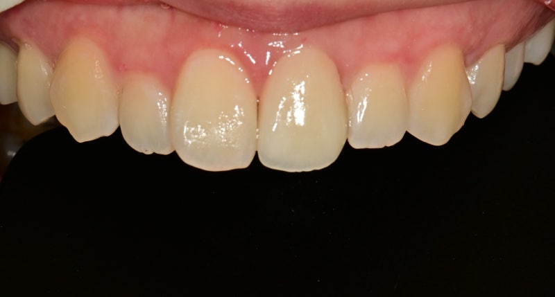 Hannam-dong Dental Clinic: Treatment Methods for Chipped Front Teeth Due to Trauma, Depending on the Extent of Damage 사진