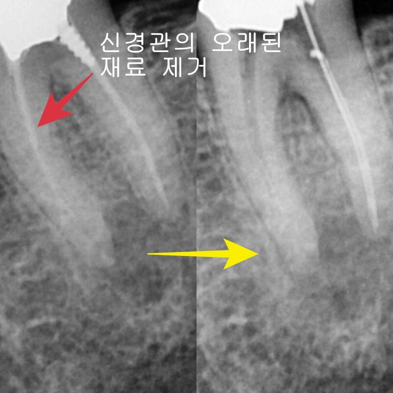 Oksu-dong Crown-Treated Tooth with Pain: Retreatment Endodontic Process 사진 10
