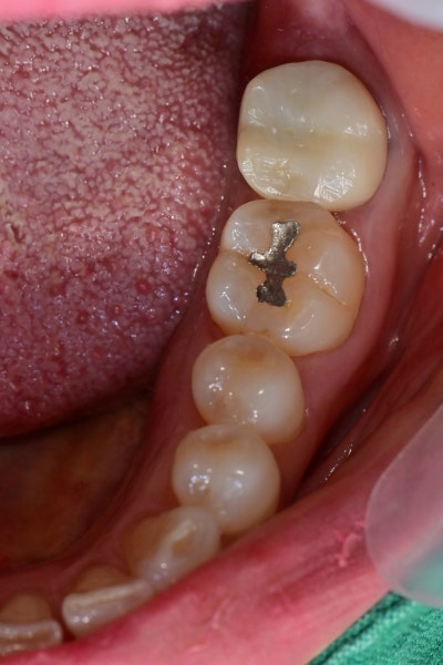 Oksu-dong Crown-Treated Tooth with Pain: Retreatment Endodontic Process 사진 8