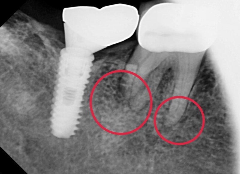 Oksu-dong Crown-Treated Tooth with Pain: Retreatment Endodontic Process 사진 3