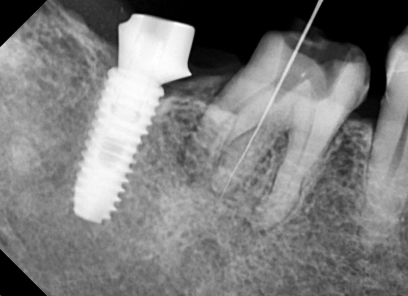 Oksu-dong Crown-Treated Tooth with Pain: Retreatment Endodontic Process 사진 4